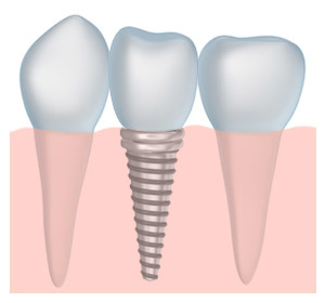implant-gum