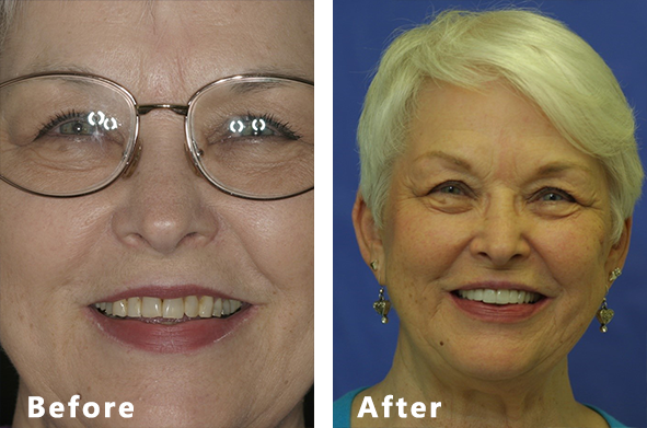 Before and after undergoing cosmetic dental treatment.