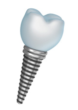 dental implant in Elgin, IL