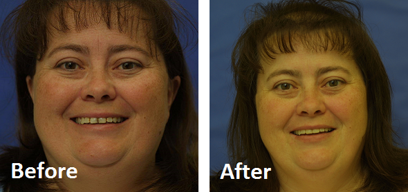 Before and after smiles from Elgin Dentist Dr. David Rice