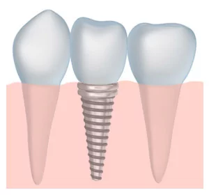 Dental implants gum demo