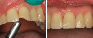 Before and after anterior composite bonding in Elgin.