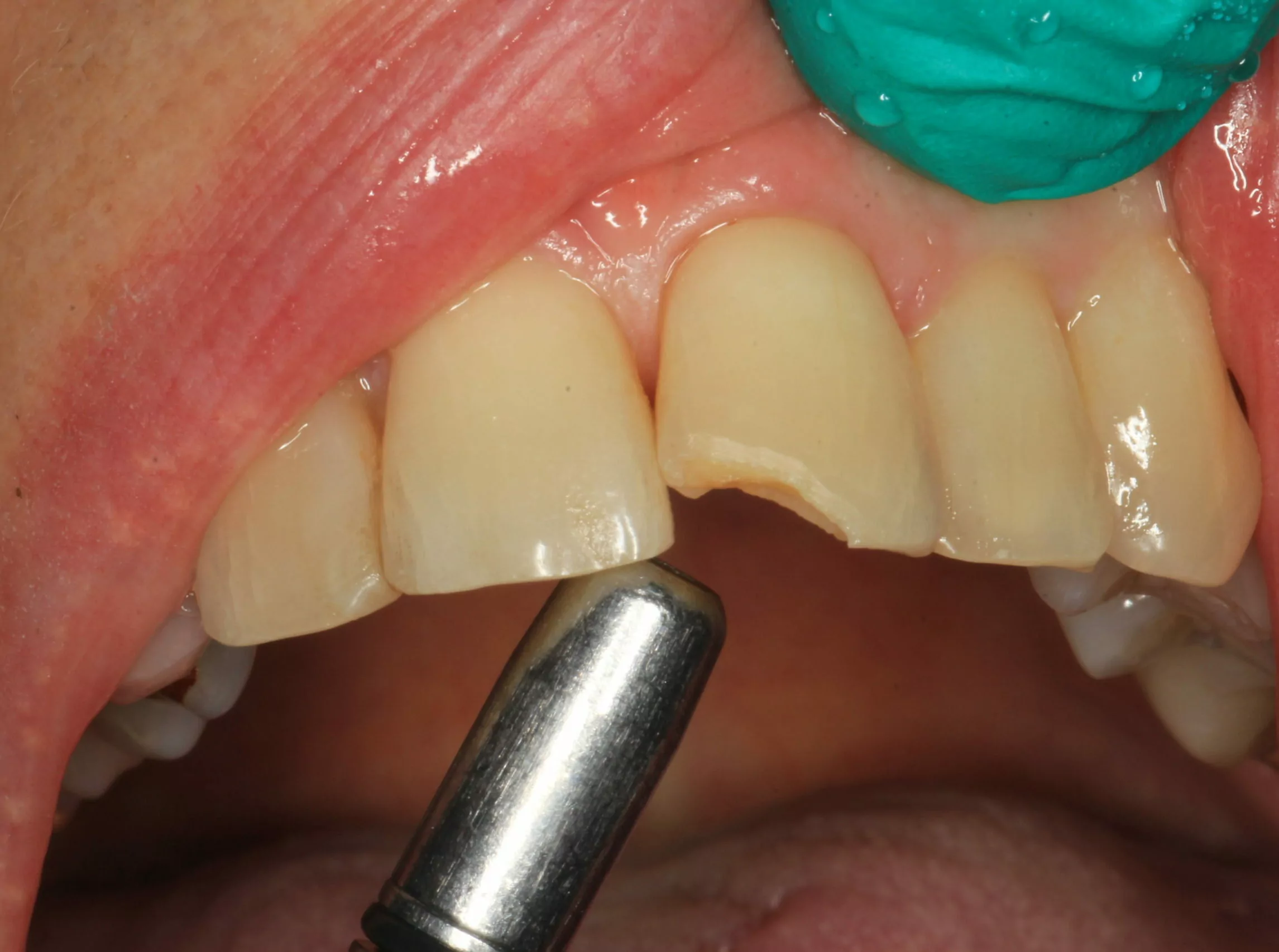 A chipped tooth being treated in Elgin.