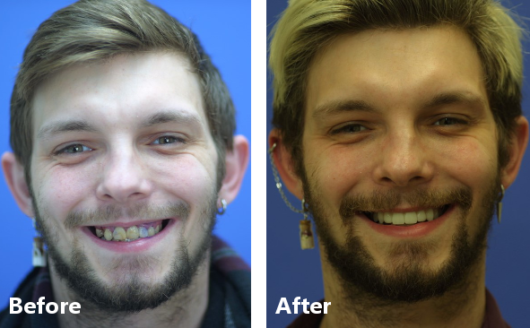 Anthony, patient of Dr. Rice, before and after receiving All on X implant dentures in Elgin, IL.