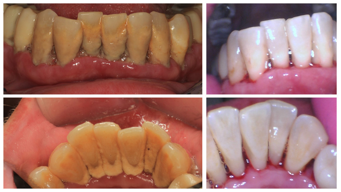 Real patient - before and after Guided Biofilm Therapy teeth cleaning
