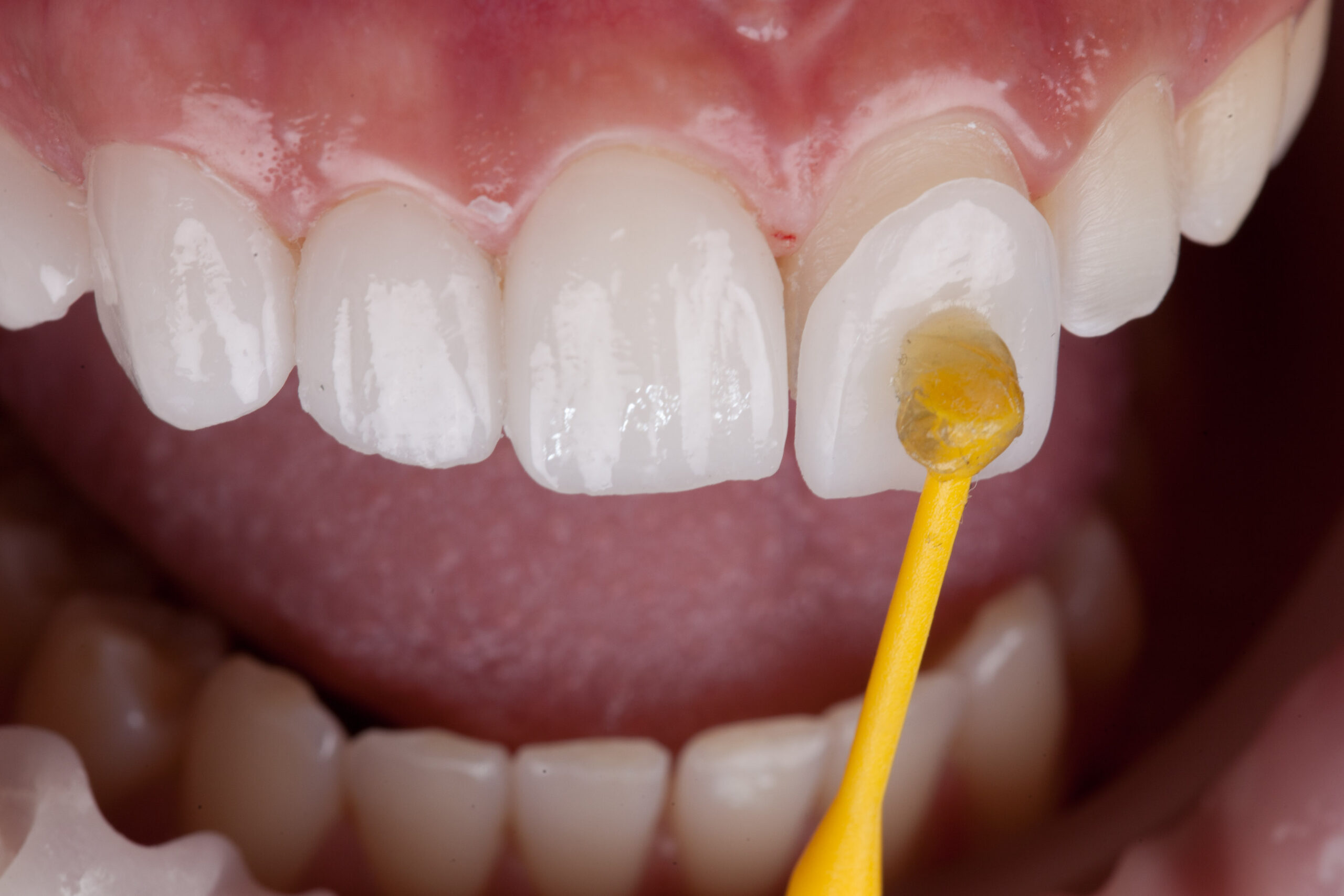 up close application of dental veneers