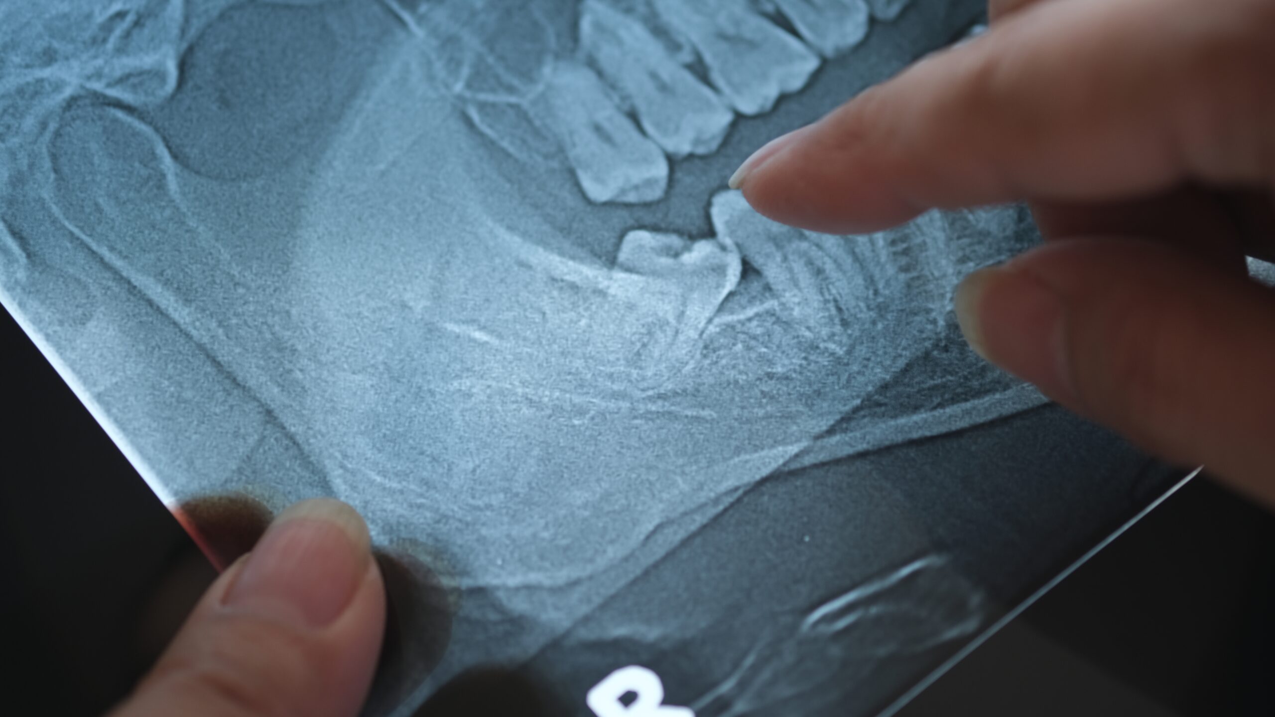 x-ray of a patients wisdom teeth