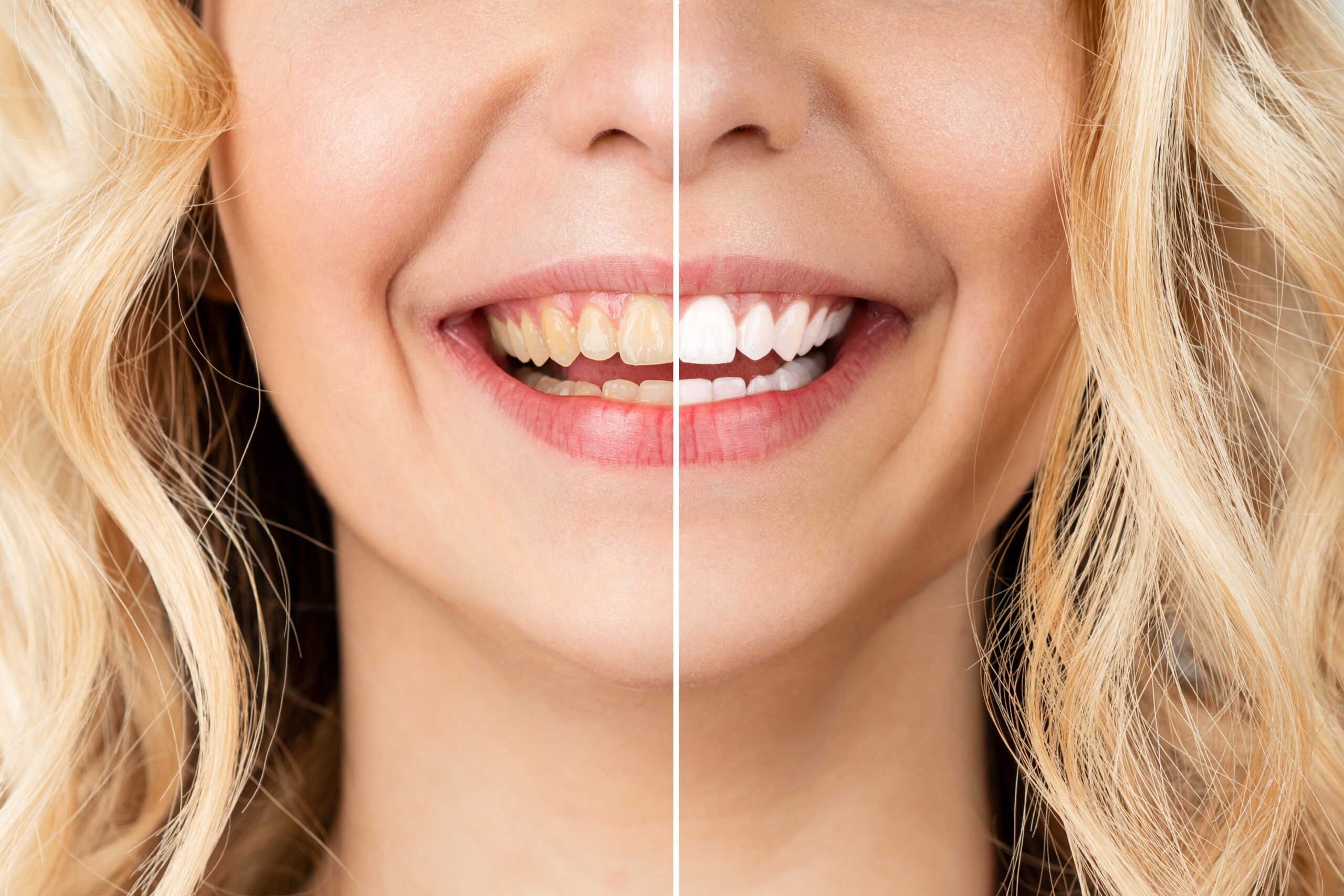 before and after, cosmetic dentistry