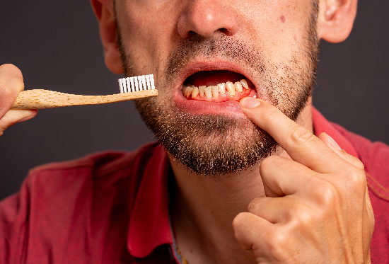 closeup of a man brushing his bleeding gums, early gum disease