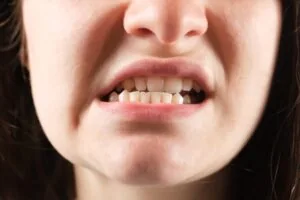 Underbite in need of occlusal adjustment.